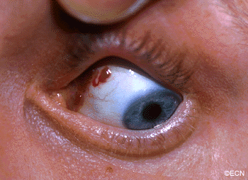 A lymphangiectasia is seen beneath the conjunctival surface. 