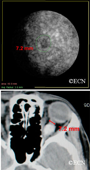 Coronal "C-scan" ultrasound can be used to compare optic nerve diameters in a case of optic nerve sheath meningioma 
