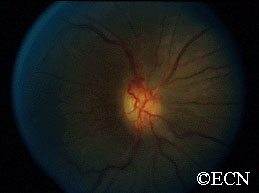 Opto-ciliary shunt vessels resulting from optic nerve compression 
