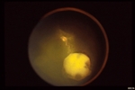 retinoblastoma_endo-full;size$150,100.ImageHandler