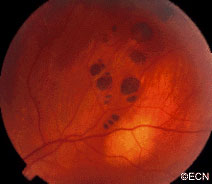 congenital hypertrophy of the retinal pigment epithelium, "bear-tracks."