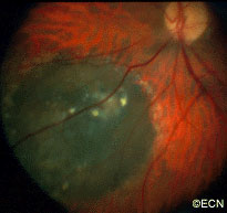 blue hued retinal pigment epithelial hypertrophy