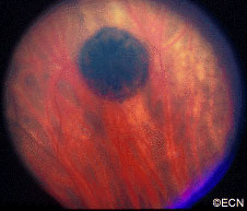 A small area of retinal pigment epithelial hypertrophy