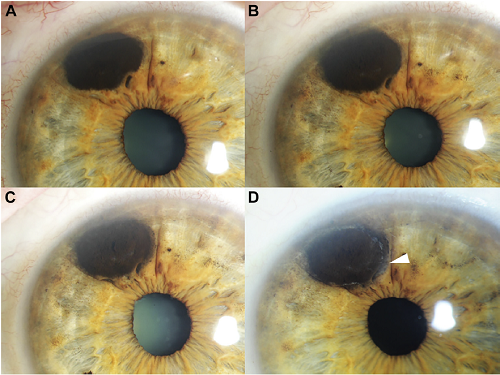 New Study Highlights Promising Treatment For Patients With Iris 